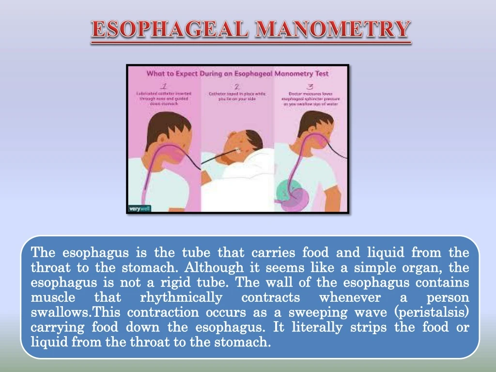 esophageal manometry