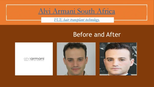 Alvi Armani South Africa Hair Transplant Johannesburg