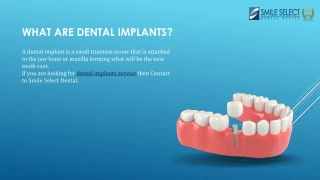 Dental Implant Services | Smile Select Dental - slide 1