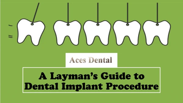 A Layman’s Guide to Dental Implant Procedure