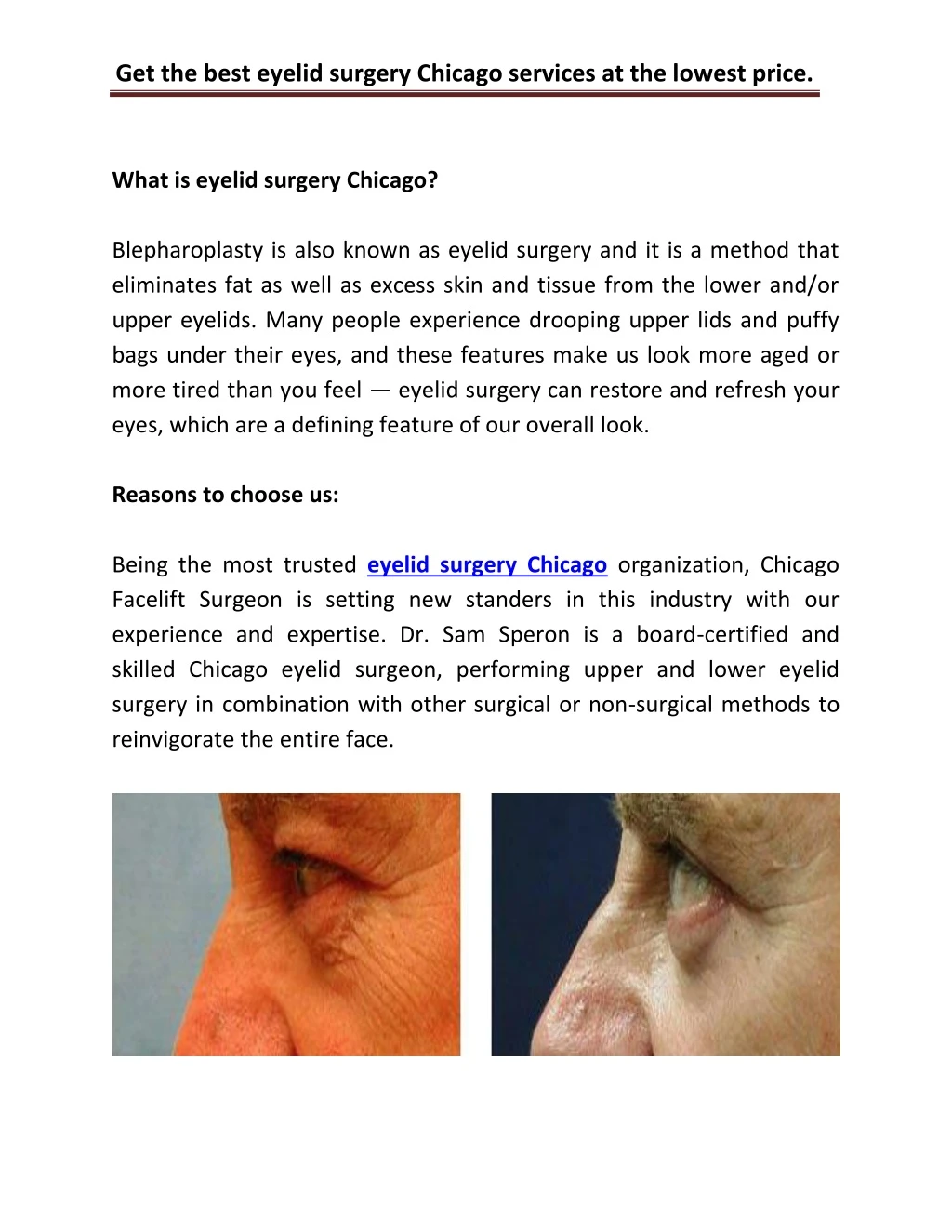 get the best eyelid surgery chicago services