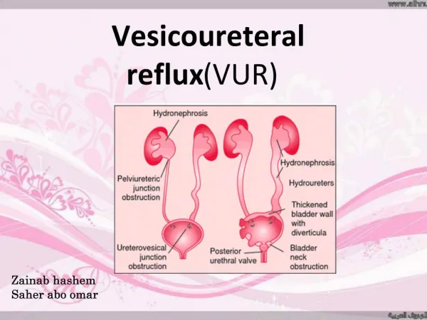 Vesicoureteral reflux VUR