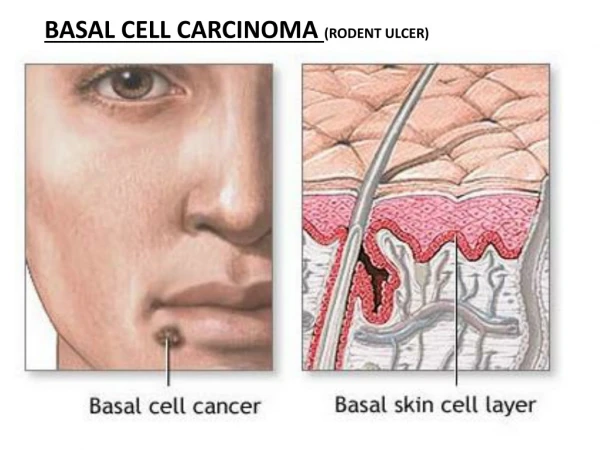 BASAL CELL CARCINOMA  ( RODENT ULCER)