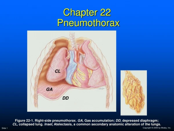 Chapter 22  Pneumothorax