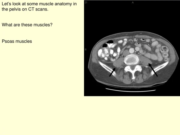 Let’s look at some muscle anatomy in the pelvis on CT scans.