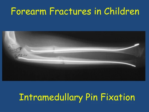 Intramedullary Pin Fixation