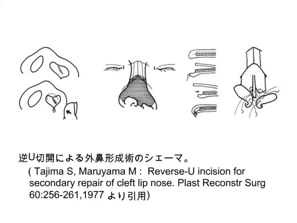 U Tajima S, Maruyama M : Reverse-U incision for secondary repair of cleft lip nose. Plast Reconstr Surg 60:256-261,19