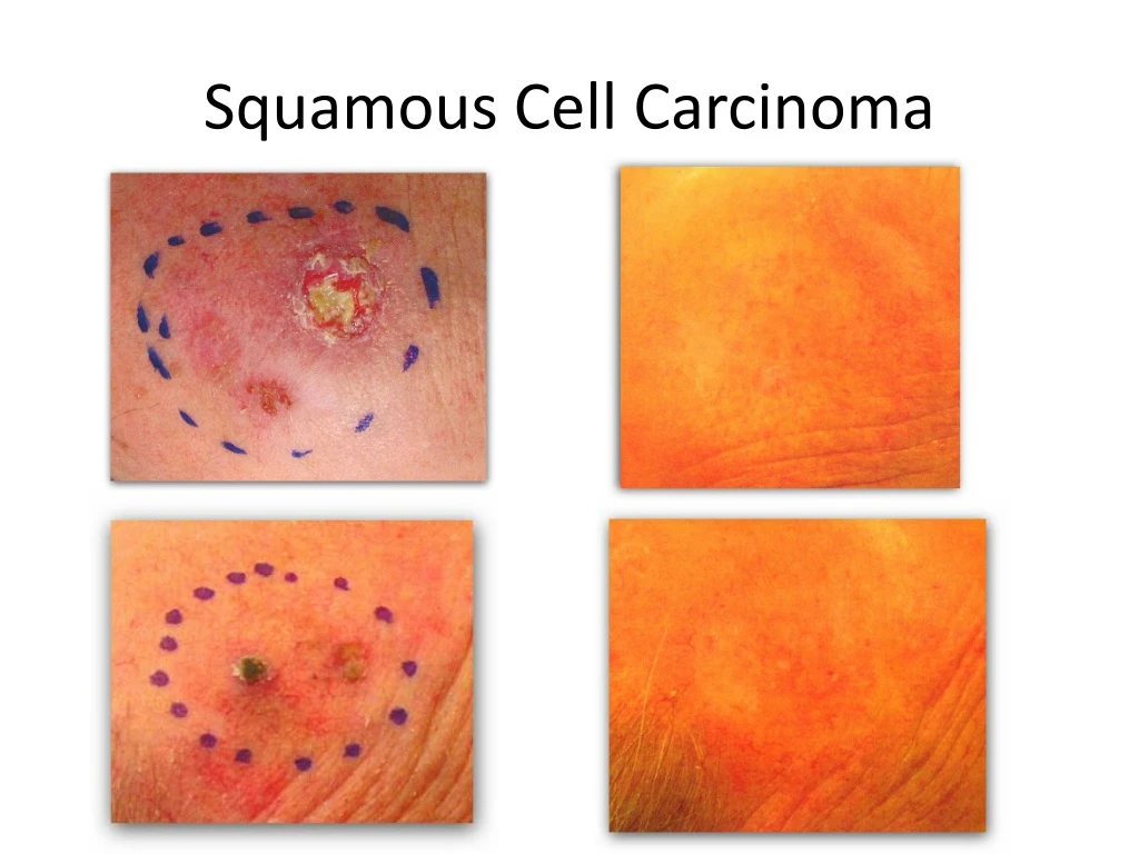 squamous cell carcinoma