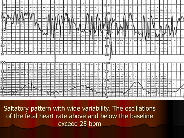 Severe variable deceleration with overshoot. However, variability is preserved.