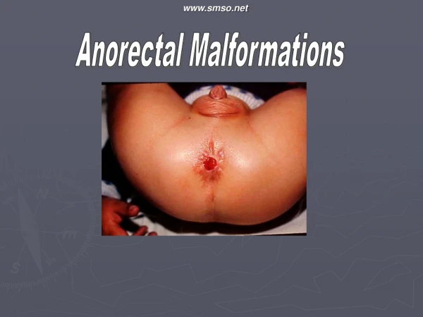 Anorectal Malformations