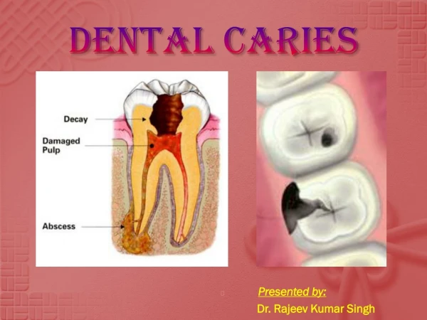 DENTAL CARIES