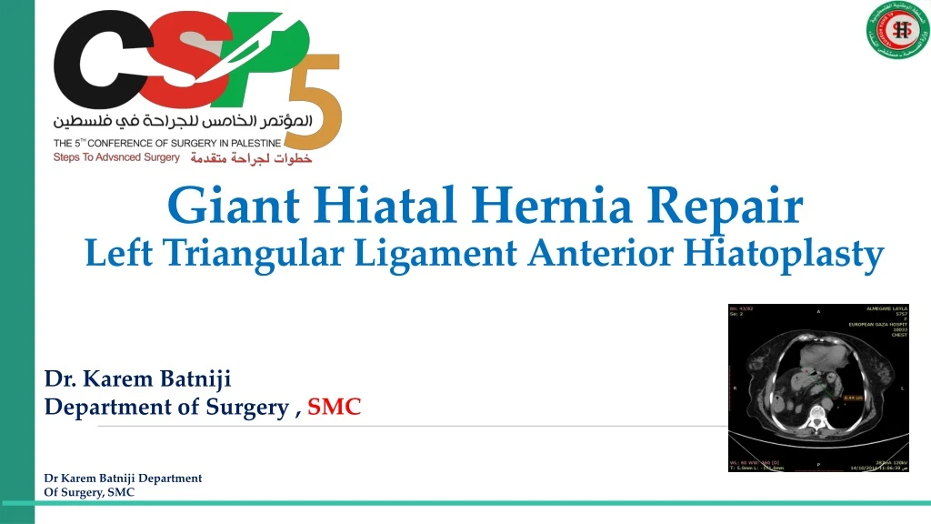 giant hiatal hernia repair left triangular ligament anterior hiatoplasty