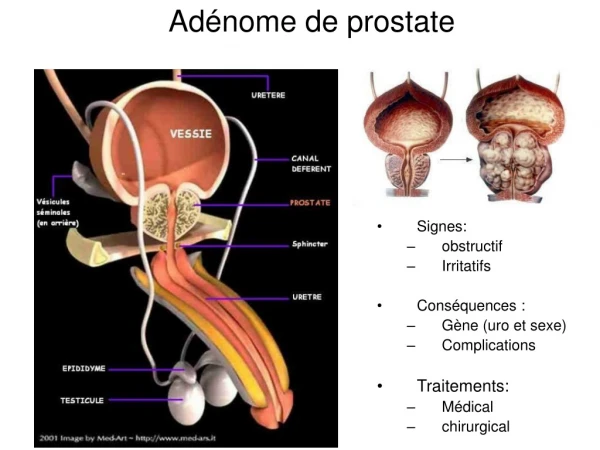 Adénome de prostate