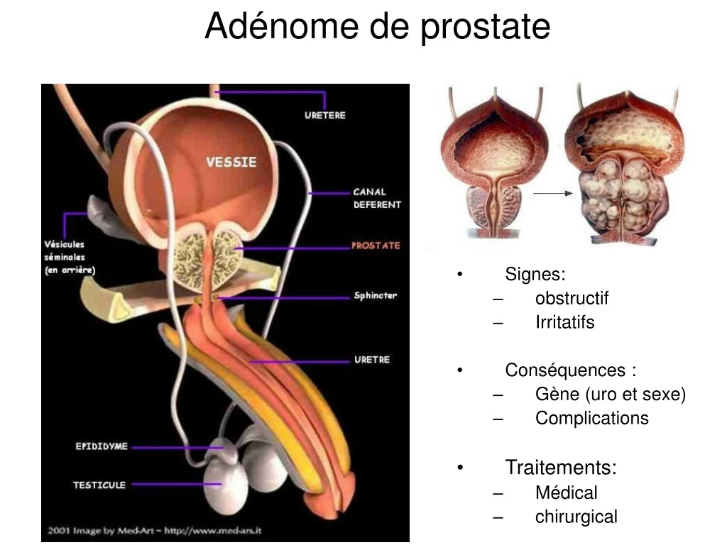 ad nome de prostate