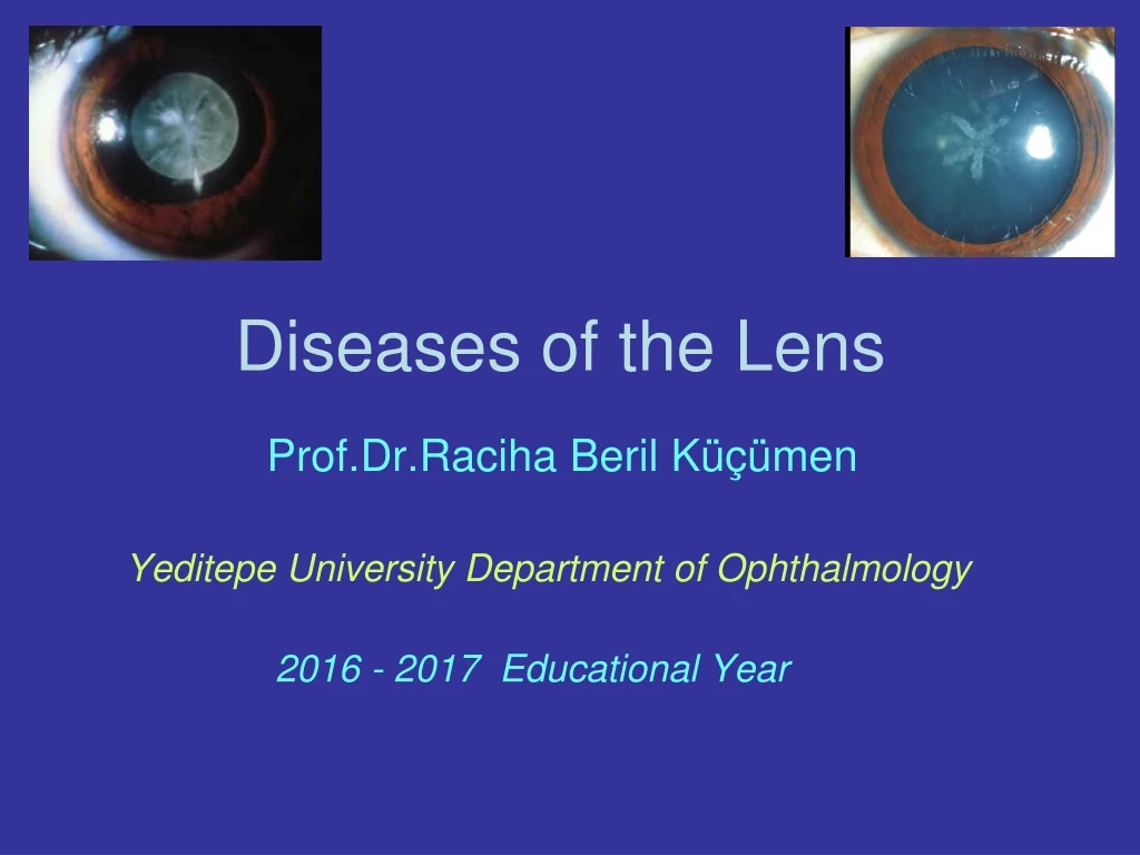 PPT - Diseases of the Lens PowerPoint Presentation, free download - ID ...