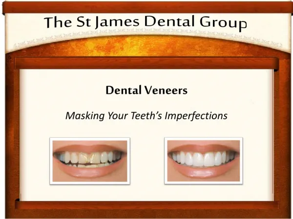 Dental Veneers will Mask Your Teeth's Imperfections