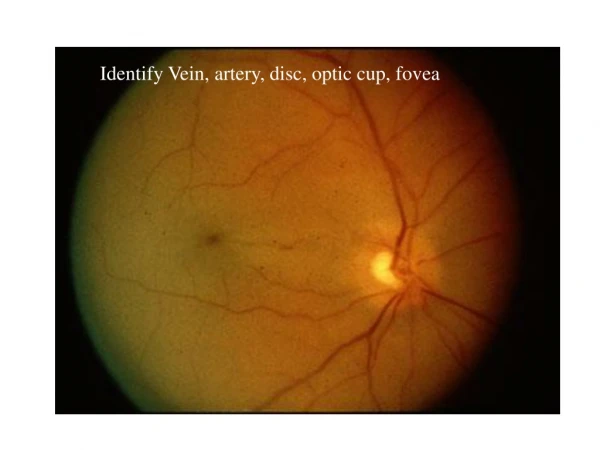 Identify Vein, artery, disc, optic cup, fovea