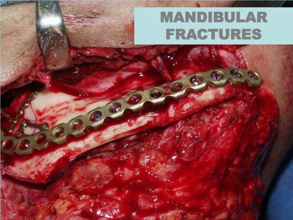 mandibular fractures