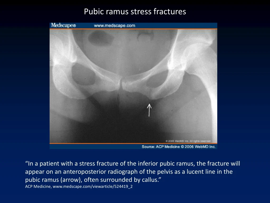 pubic ramus stress fractures