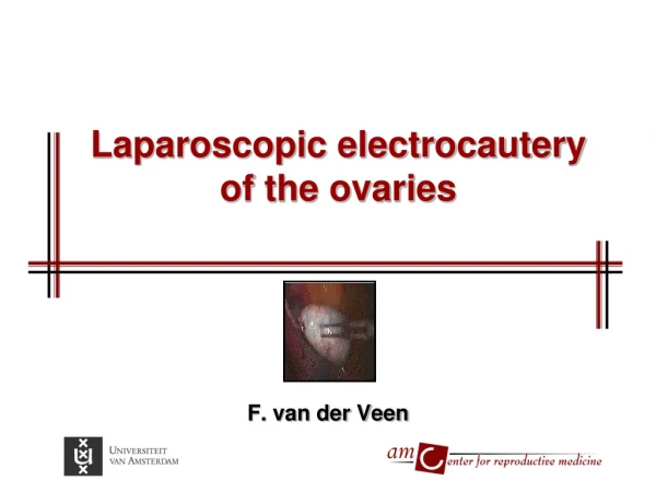 Laparoscopic electrocautery  of the ovaries