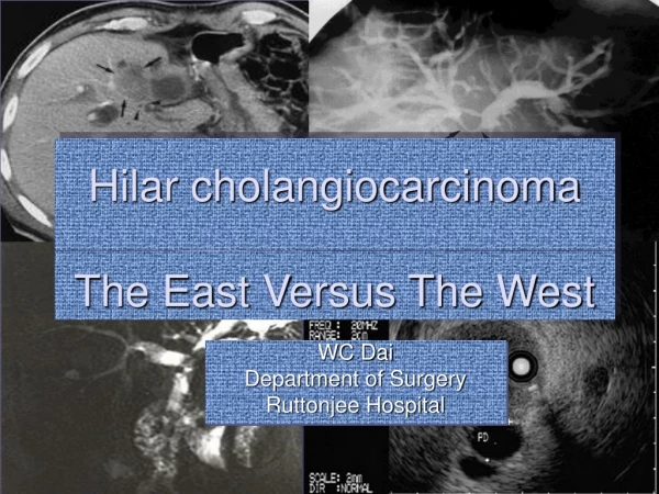 Hilar cholangiocarcinoma The East Versus The West
