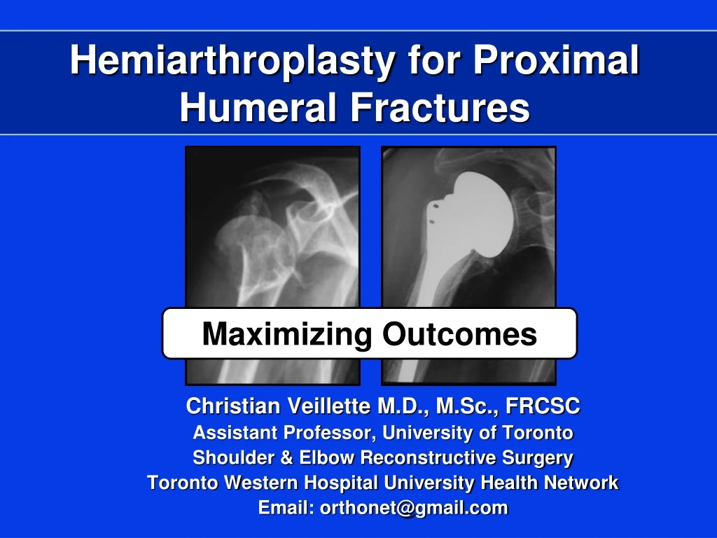 hemiarthroplasty for proximal humeral fractures