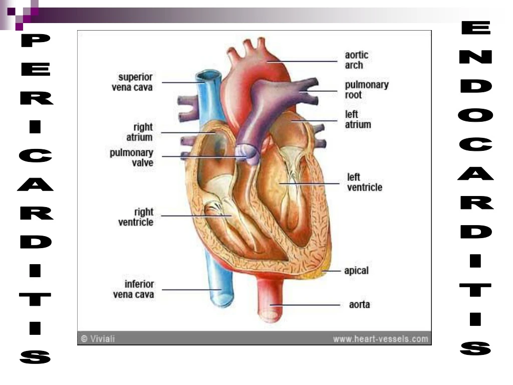 endocarditis