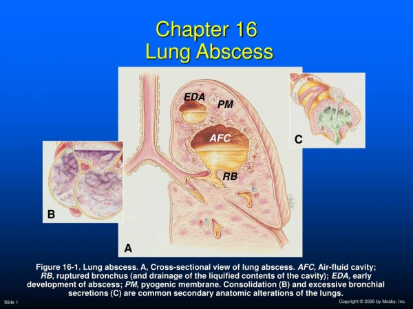 Chapter 16  Lung Abscess