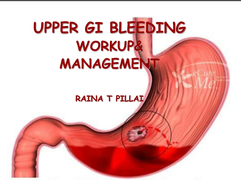 upper gi bleeding workup management raina t pillai