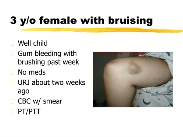 3 y/o female with bruising