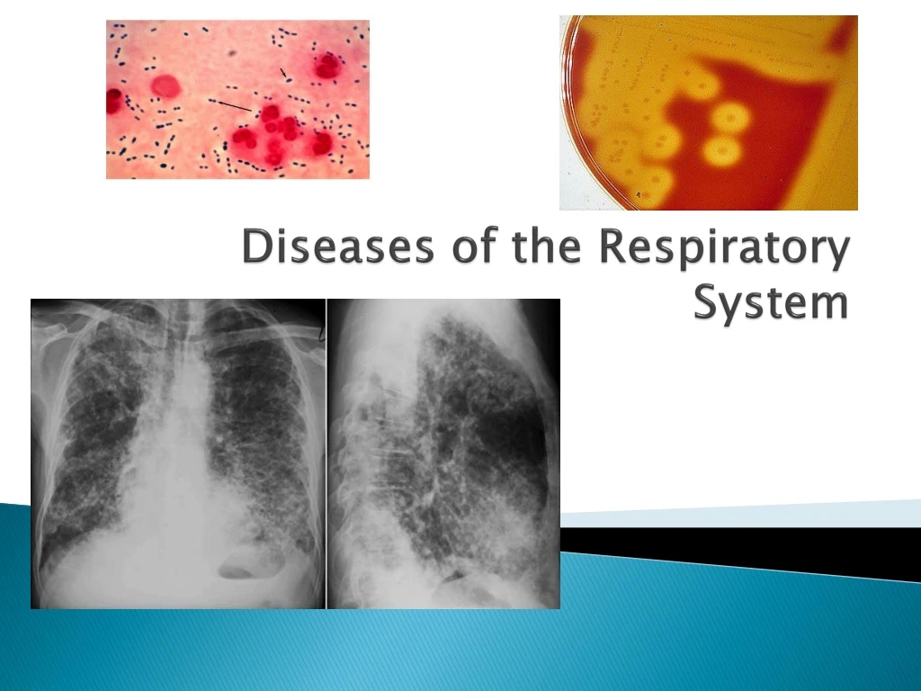 diseases of the respiratory system