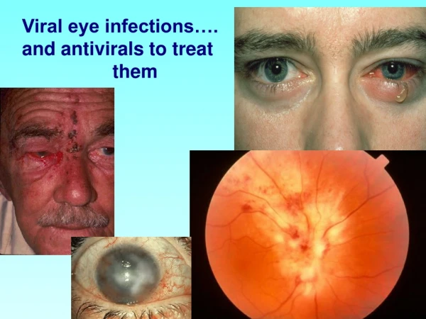 Viral eye infections…. and antivirals to treat 		 them