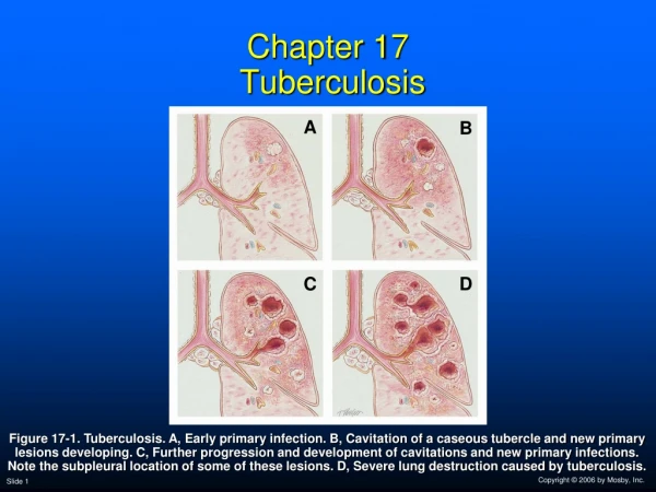 Chapter 17  Tuberculosis