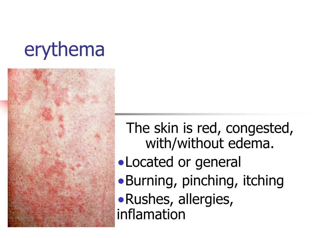 erythema