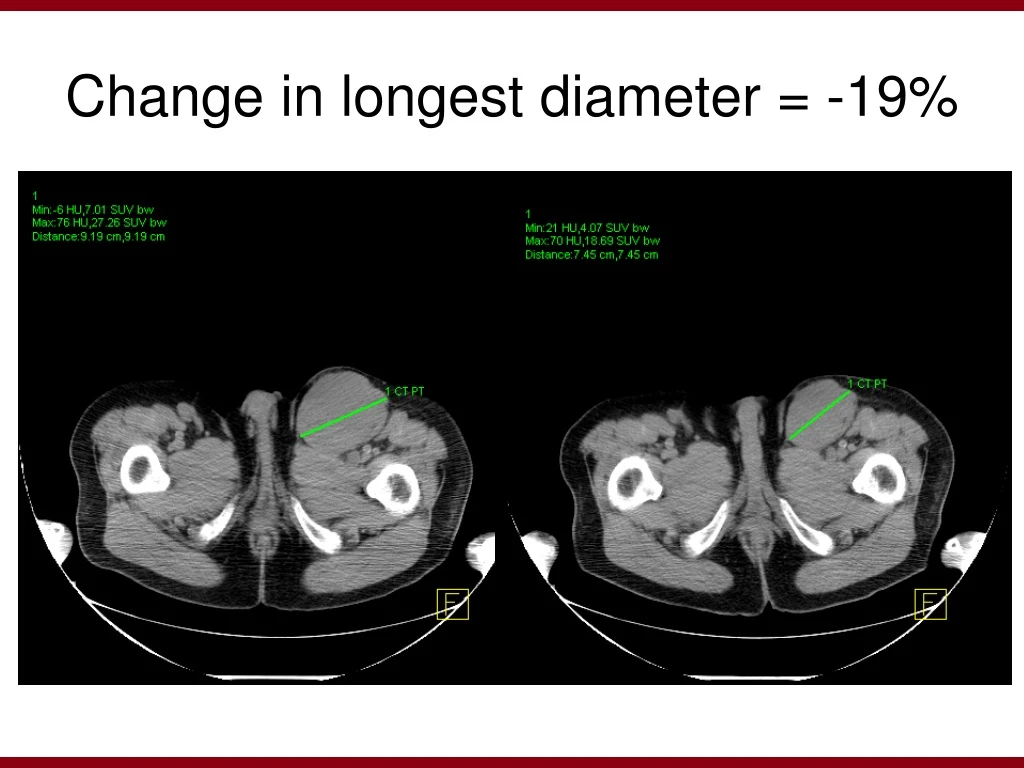 change in longest diameter 19