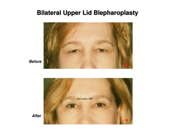 Bilateral Upper Lid Blepharoplasty