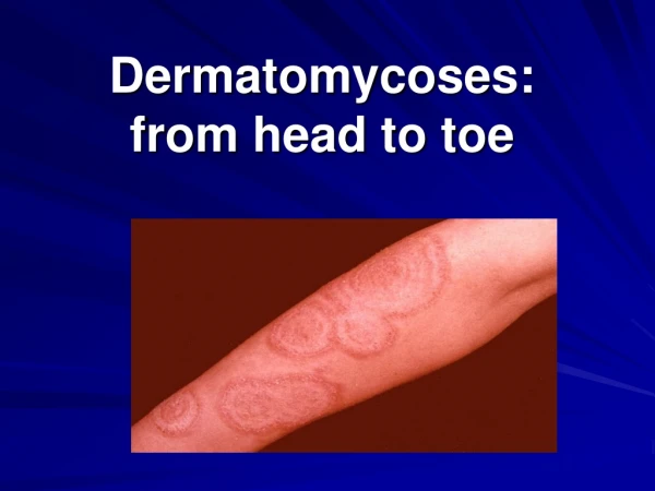 Dermatomycoses :  from head to toe