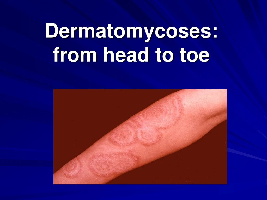 dermatomycoses from head to toe