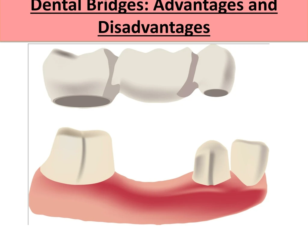 dental bridges advantages and disadvantages