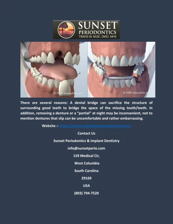 there are several reasons a dental bridge