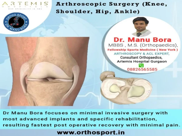 Arthroscopic Surgery in Gurgaon (Knee, Shoulder, Hip, Ankle)