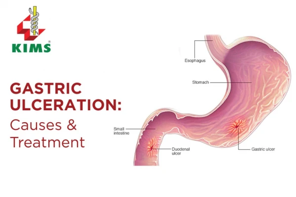 Gastric Ulceration - Causes and Treatment | KIMS Trivandrum