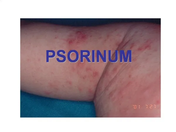 PSORINUM