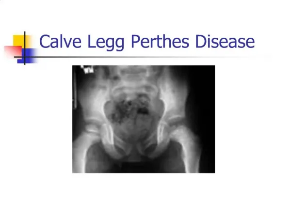 Calve Legg Perthes Disease
