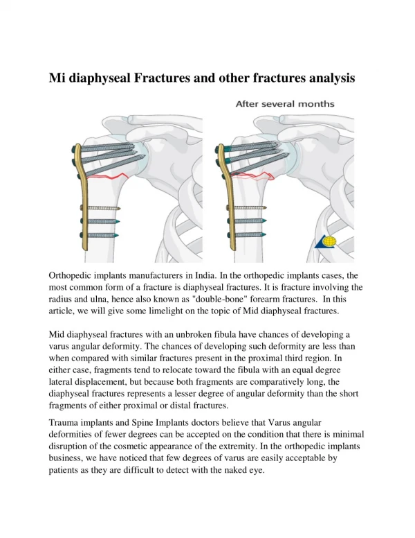 Mi diaphyseal Fractures and other fractures analysis