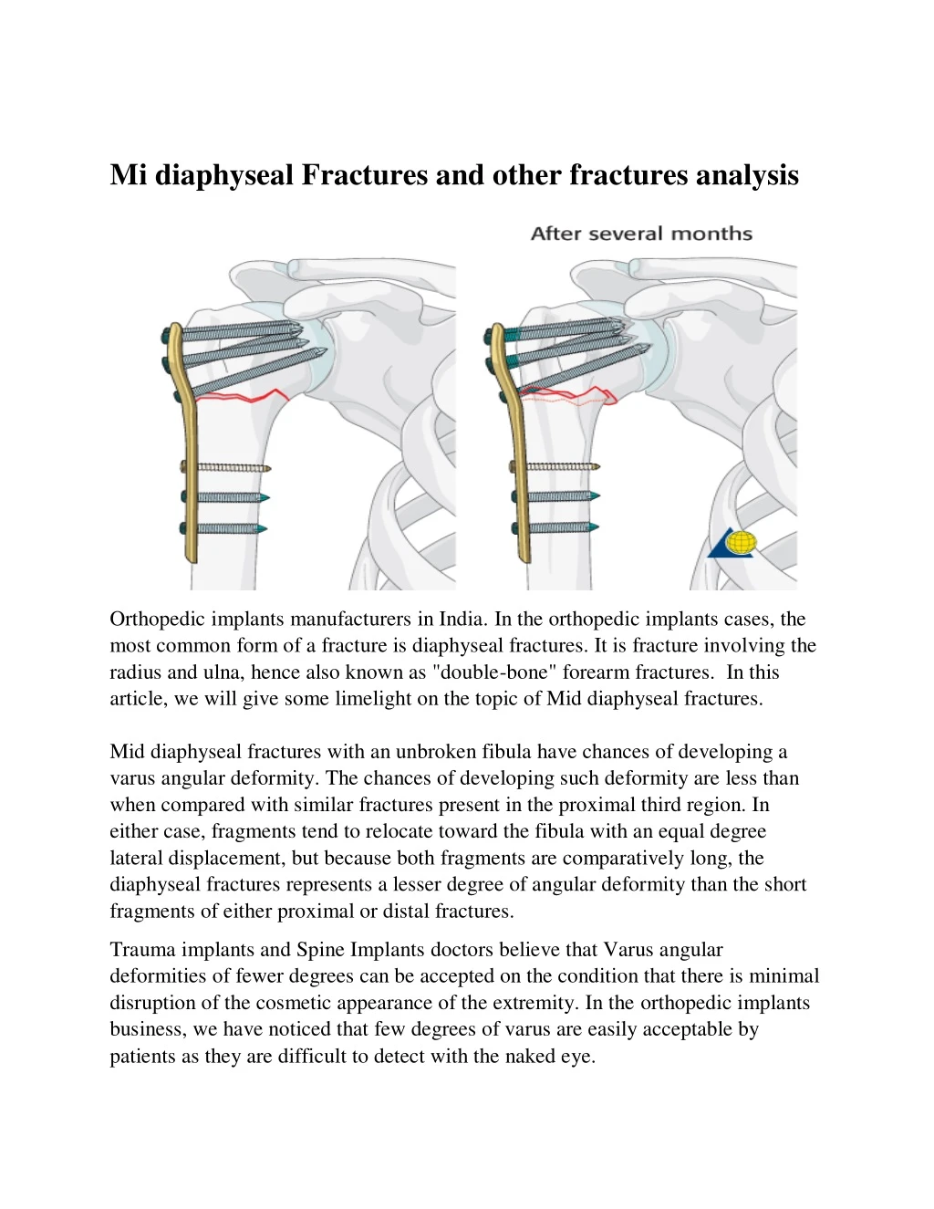 mi diaphyseal fractures and other fractures
