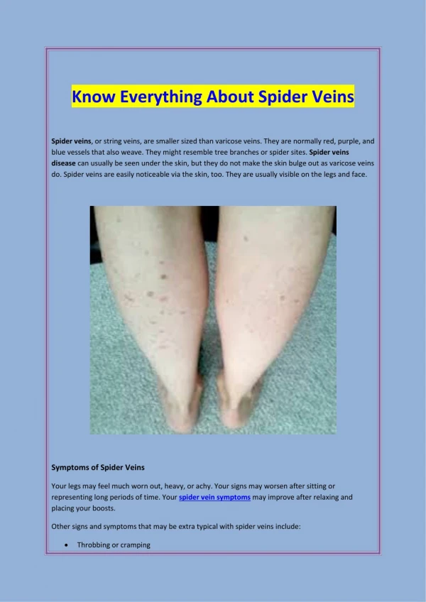 Know Everything About Spider Veins