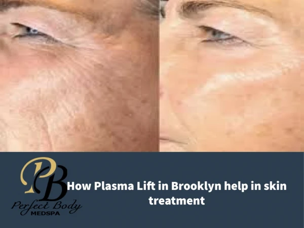 How Plasma Lift in Brooklyn help in skin treatment