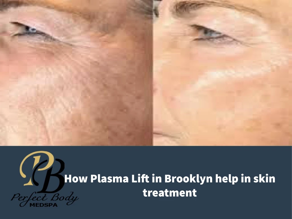 how plasma lift in brooklyn help in skin treatment