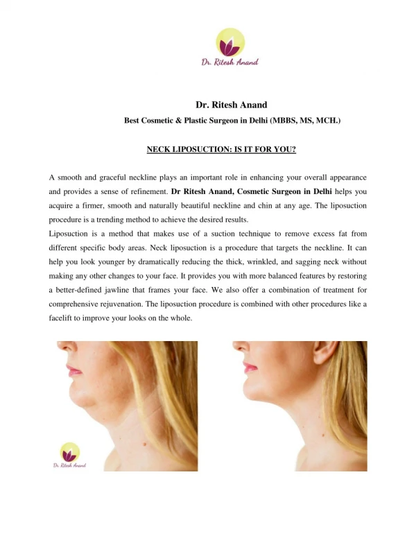 Neck Liposuction – Is It For You?